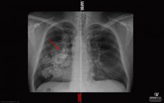 pulmones.jpg